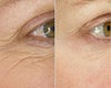 Wrinkle Treatment before & after photos