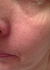 Face with large pores, mild acne scars, etc.