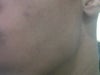 upper cheek