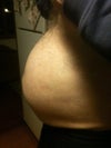 Scars around naval due to hernia repair.