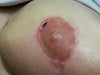 Left breast with normal, expected healing. ZERO issues or complaints 26 days post op.