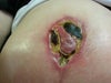 Right breast not on track with the left. Recessed nipple, scabs, areola/breast incision line not healing, DEEP scabs with yellow/dark pus/drainage.  Photo taken after wearing nursing pad with Neosporin for 10 hrs.