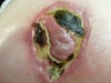 Closer view of right breast. PS is not concerned due to healthy nipple tissue present. When I lifted edge of scab, there was white/yellow tissue under with foul stench pus looking goo, but no pink nipple tissue.