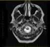 T2 MRI Image 1 - was done of brain but shows nose