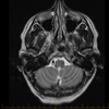 T2 MRI Image 3. different angle.