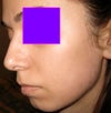 19 days post-op