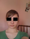 POST op. kind of difficult to see from my poor quality camera, but the nose now looks very crooked, with the septum slanting to one side.