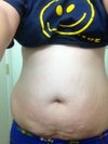 My stretch marks don't bother me, but my belly and "muffin top" does
