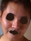 mild acne scar
