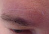 Scar over right eyebrow at 3 months healing time.