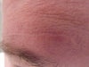 Raised and more noticeable near center of forehead but thinner portion does not run parallel enough to match other wrinkles.