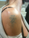 can picosure remove this tattoo?