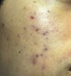 2011 nov 20 - right cheek - elevated red areas
