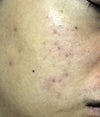 2012 nov 20 - right cheek - flat red areas