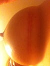 Hypertrophic scar