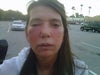 The beginning of swelling more on right , more filler was put on the right, since has gotten worse