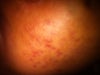 the other cheek with the same conditions as the other cheek.