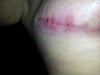 Infection/small holes
