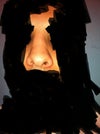 Scarred overresected nostrils and overresected dorsum with visible indentations on sidewalls.