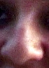 Before Rhinoplasty