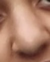 After Rhinoplasty