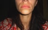 nasolabial folds