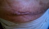 end of incision
