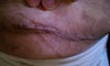 end of incision