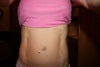 Umbilical Hernia