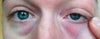 Here is a shot pulling my skin tight with the red color still there.