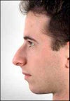 Tethered lip due to large nasal spine