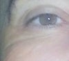 Now under left eye....