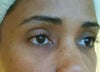3 weeks after Restylane.