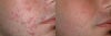 Accutane before & after photos