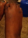 my legs where some of the scars are they are all the some on both my legs,some evn bigger