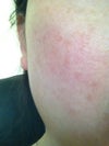 Pigmentation