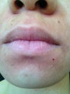 Pigmentation and recent acne
