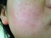 Pigmentation