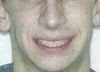 Front shot immediately after treatment.