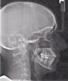X-ray now (years after treatment).  I feel as though my face was not allowed to grow the way it should have.  I know I would still have a recessed mandible without treatment, but that is easier to fix than a recessed maxilla and mandible. Is there any merit to this?  What are my options for fixing my jaw/profile at this point?