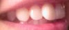 I dislike this front flaring tooth tremendously you can really see it from the side not so much from the front but my tooth keeps me from smiling..