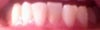 Bottom row of teeth is where most of the crowding is ..I call them tombstone teeth ugh they have shifted over time are otherwise healthy just went in for a cleaning last 6 months. P.S. I have had all my wisdom teeth pulled