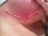 Post op week 3. Red and irritated with sharp "abscess like" pain.