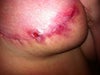 Post op week 7 after 2 rounds of antibiotics.