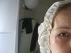Scar tissue four weeks post lower blepharoplasty