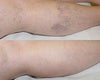 Sclerotherapy Before and After Photos