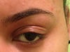 Extra creases or eyelid skin?