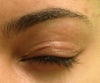 Eyes closed showing incision bump and extra creases or skin