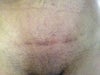 My unhappy scar