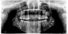Further Reducing a Chin with prior Genioplasty